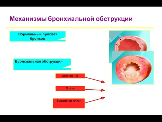 Механизмы бронхиальной обструкции Отек стенок Спазм Нормальный просвет бронхов Бронхиальная обструкция Выделение слизи