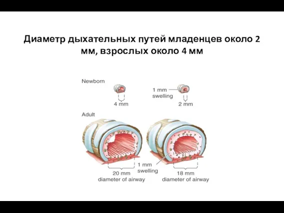 Диаметр дыхательных путей младенцев около 2 мм, взрослых около 4 мм