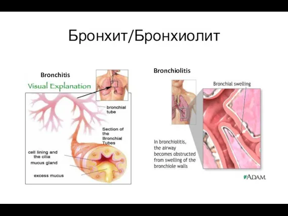 Бронхит/Бронхиолит Bronchiolitis Bronchitis