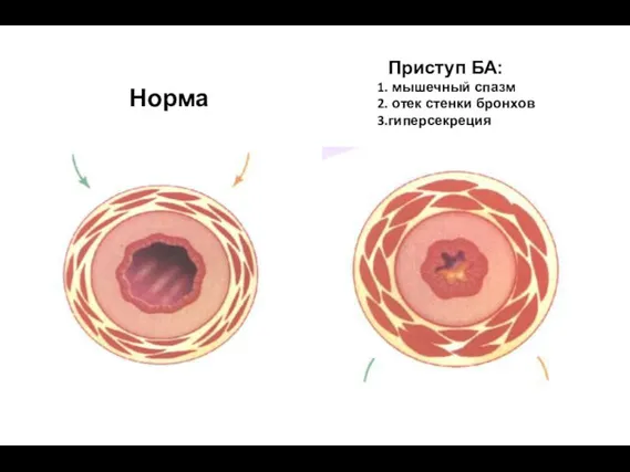 Норма Приступ БА: мышечный спазм отек стенки бронхов гиперсекреция