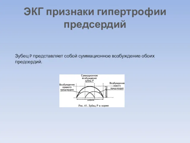 ЭКГ признаки гипертрофии предсердий Зубец P представляет собой суммационное возбуждение обоих предсердий.