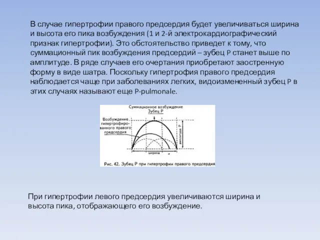 При гипертрофии левого предсердия увеличиваются ширина и высота пика, отображающего