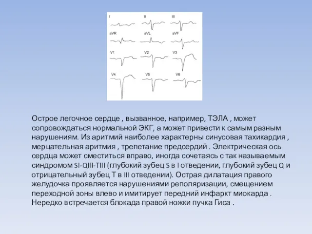 Острое легочное сердце , вызванное, например, ТЭЛА , может сопровождаться