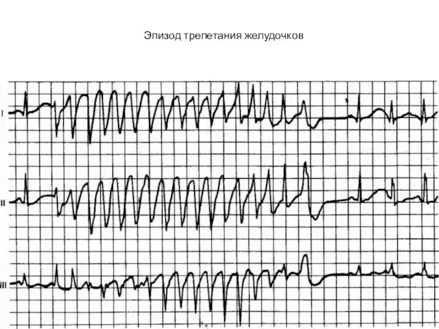 Эпизод трепетания желудочков
