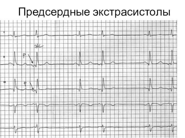 Предсердные экстрасистолы