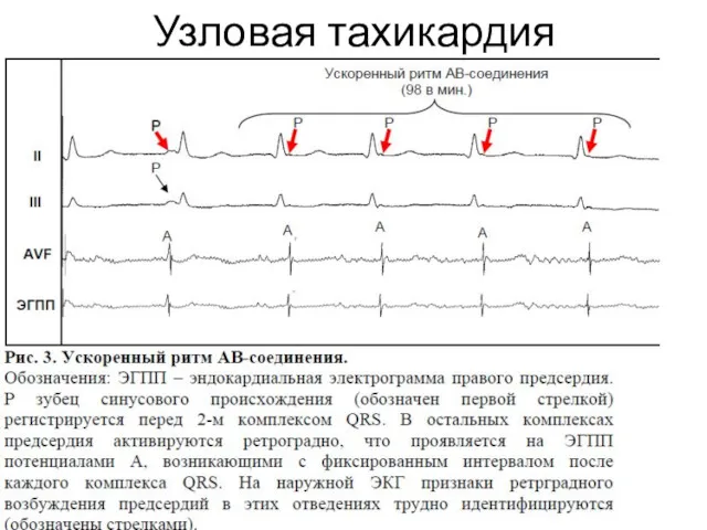 Узловая тахикардия