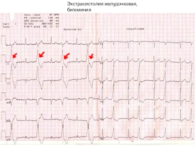 Экстрасистолия желудочковая, бигеминия