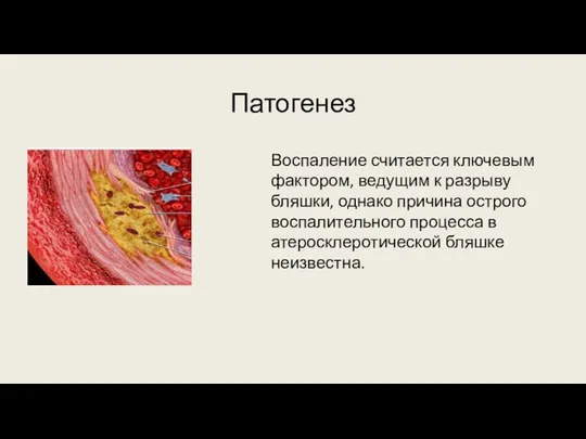 Патогенез Воспаление считается ключевым фактором, ведущим к разрыву бляшки, однако