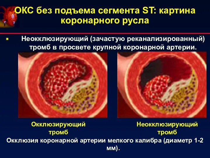 ОКС без подъема сегмента ST: картина коронарного русла Неокклюзирующий (зачастую