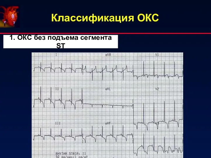 Классификация ОКС 1. ОКС без подъема сегмента ST