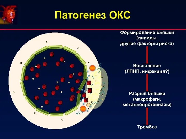 Патогенез ОКС Формирование бляшки (липиды, другие факторы риска) Воспаление (ЛПНП, инфекция?) Разрыв бляшки (макрофаги, металлопротеиназы) Тромбоз