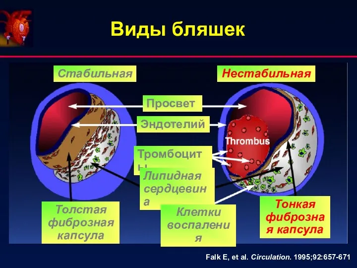 Виды бляшек Falk E, et al. Circulation. 1995;92:657-671 Стабильная Нестабильная