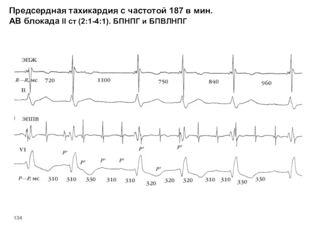 Предсердная тахикардия с частотой 187 в мин. АВ блокада II ст (2:1-4:1). БПНПГ и БПВЛНПГ