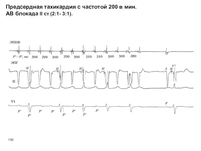 Предсердная тахикардия с частотой 200 в мин. АВ блокада II ст (2:1- 3:1).