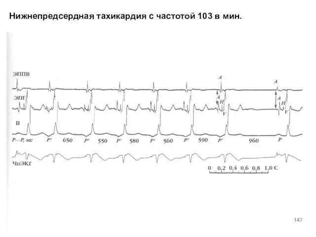 Нижнепредсердная тахикардия с частотой 103 в мин.