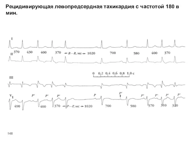 Рецидивирующая левопредсердная тахикардия с частотой 180 в мин.