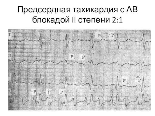 Предсердная тахикардия с АВ блокадой II степени 2:1