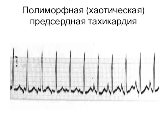 Полиморфная (хаотическая) предсердная тахикардия