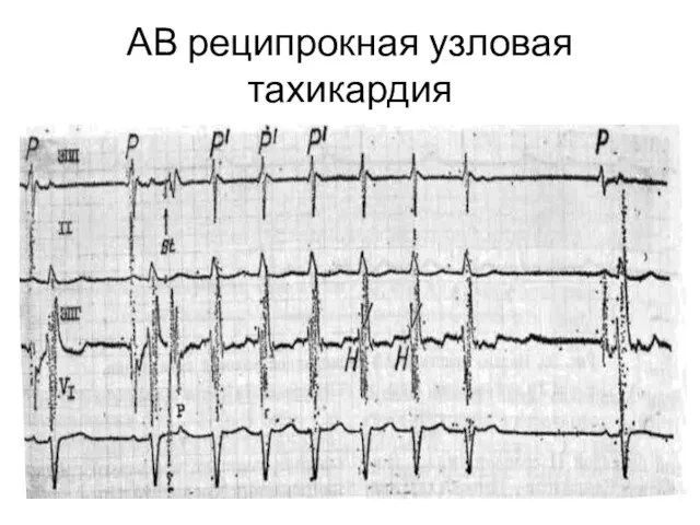 АВ реципрокная узловая тахикардия