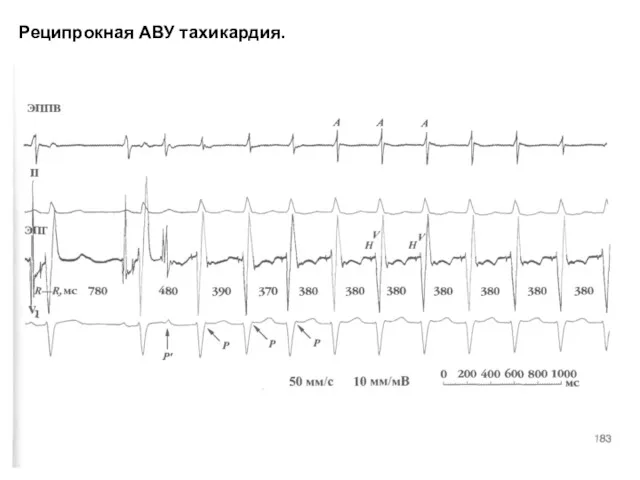 Реципрокная АВУ тахикардия.