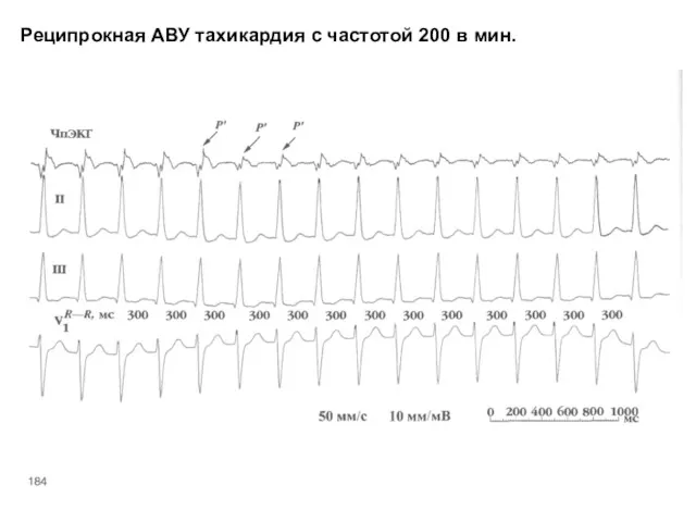 Реципрокная АВУ тахикардия с частотой 200 в мин.