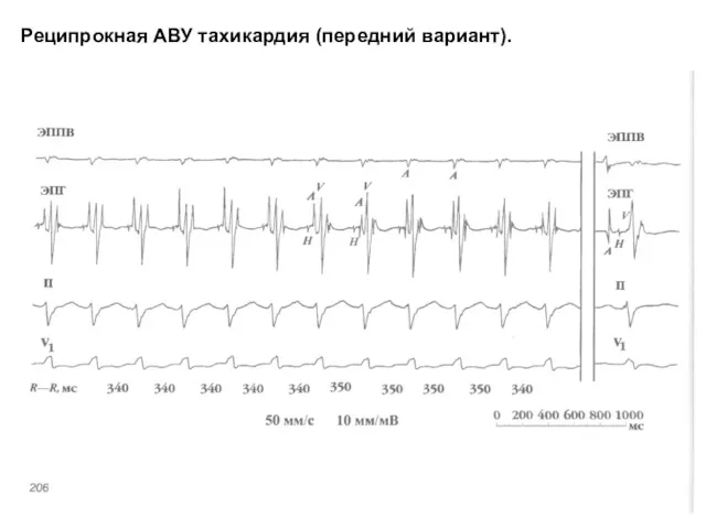 Реципрокная АВУ тахикардия (передний вариант).