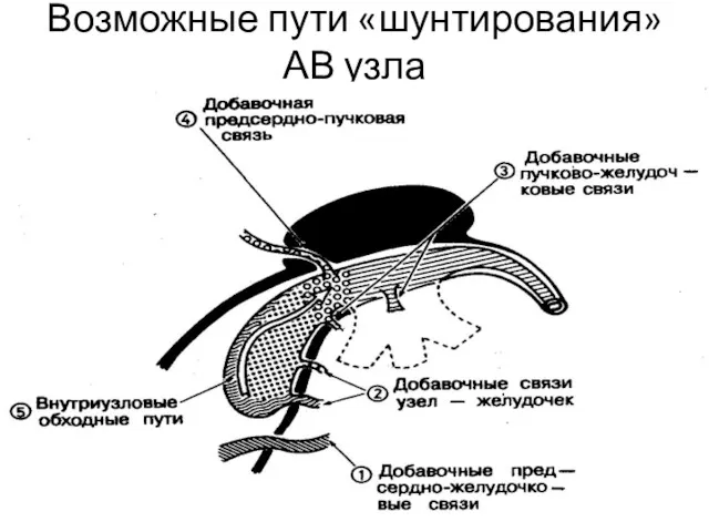 Возможные пути «шунтирования» АВ узла