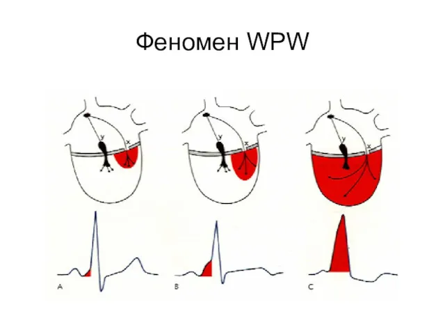 Феномен WPW