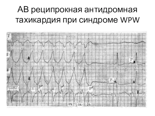 АВ реципрокная антидромная тахикардия при синдроме WPW