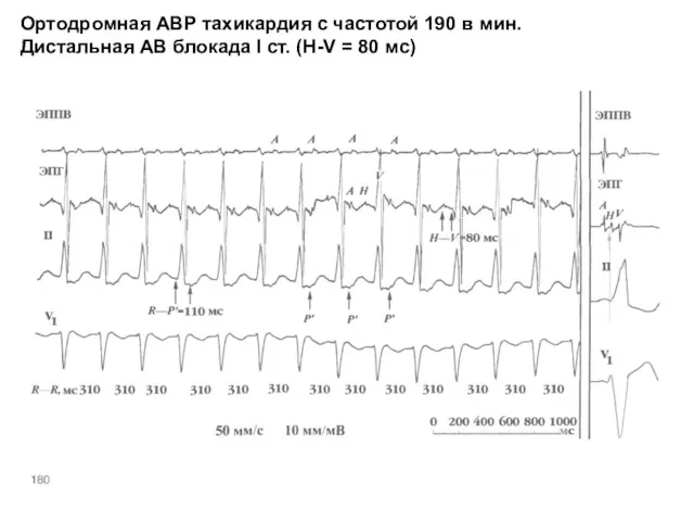 Ортодромная АВР тахикардия с частотой 190 в мин. Дистальная АВ