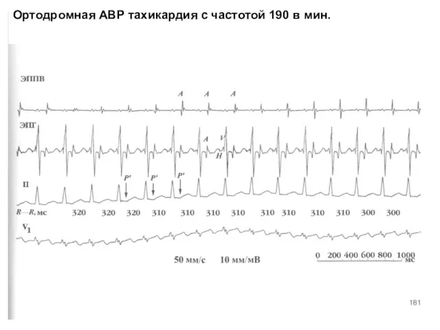 Ортодромная АВР тахикардия с частотой 190 в мин.