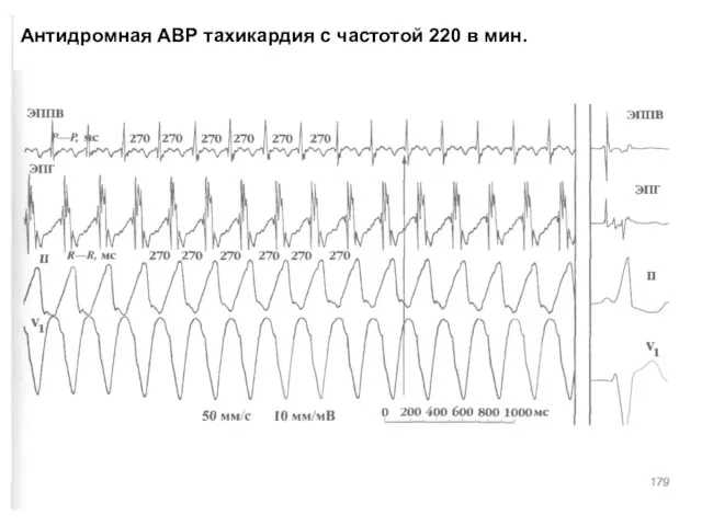 Антидромная АВР тахикардия с частотой 220 в мин.