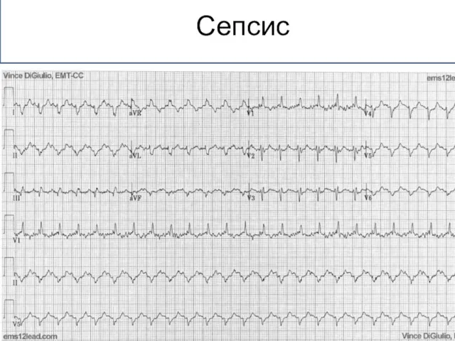 Сепсис