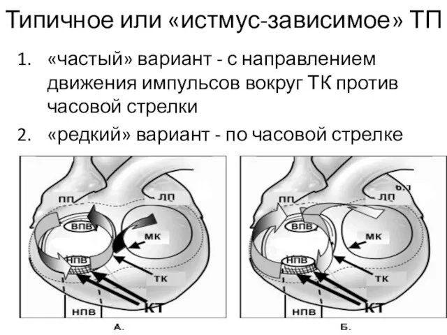 Типичное или «истмус-зависимое» ТП «частый» вариант - с направлением движения