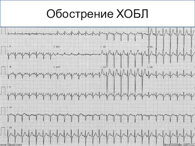 Обострение ХОБЛ