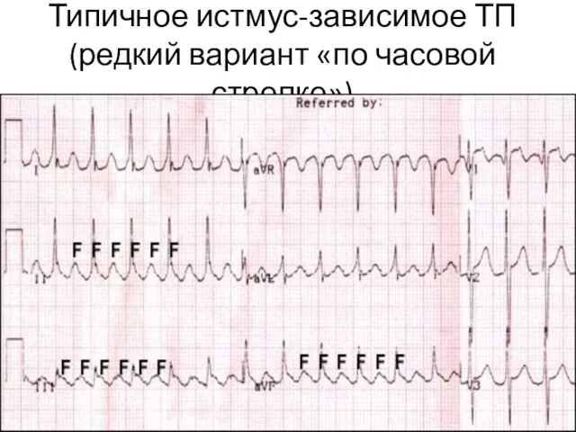 Типичное истмус-зависимое ТП (редкий вариант «по часовой стрелке»)