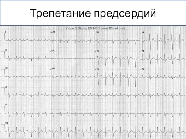 Трепетание предсердий