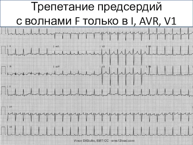 Трепетание предсердий с волнами F только в I, AVR, V1