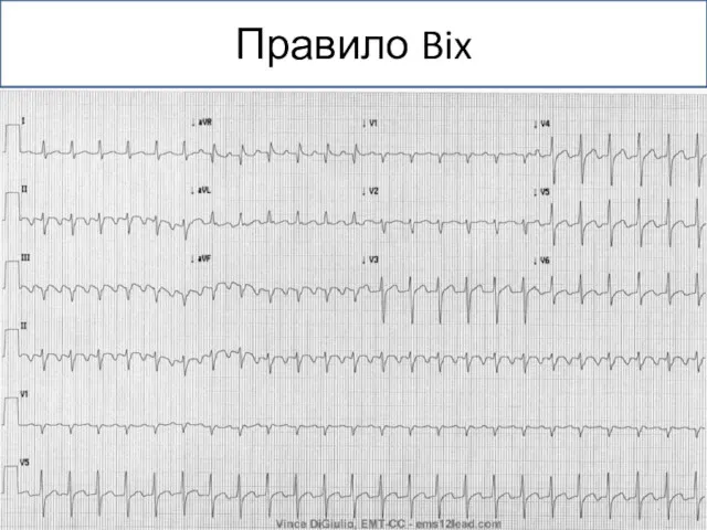 Правило Bix