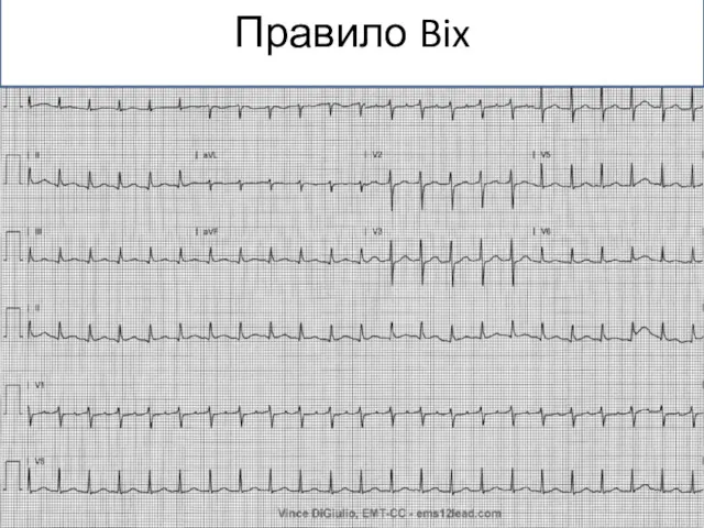 Правило Bix