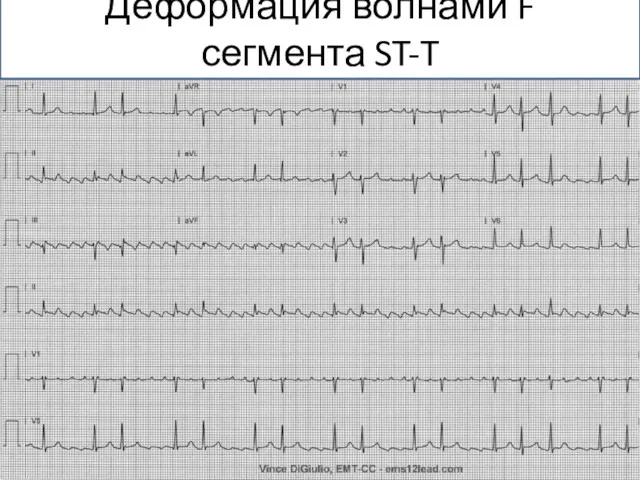 Деформация волнами F сегмента ST-T