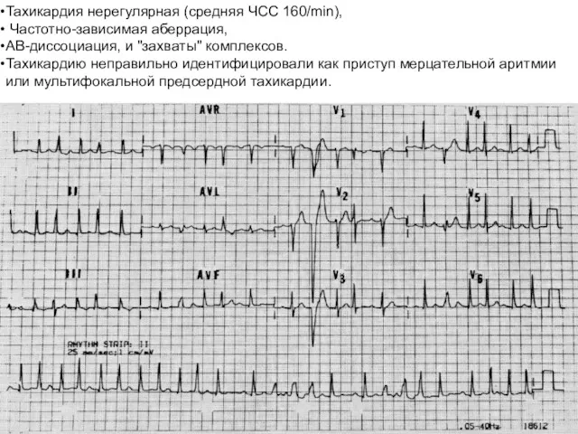 Тахикардия нерегулярная (средняя ЧСС 160/min), Частотно-зависимая аберрация, АВ-диссоциация, и "захваты"