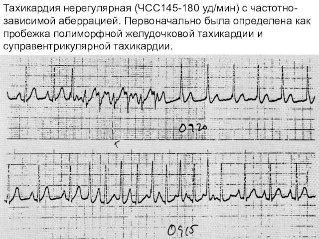 Тахикардия нерегулярная (ЧСС145-180 уд/мин) с частотно-зависимой аберрацией. Первоначально была определена