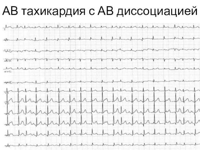 АВ тахикардия с АВ диссоциацией