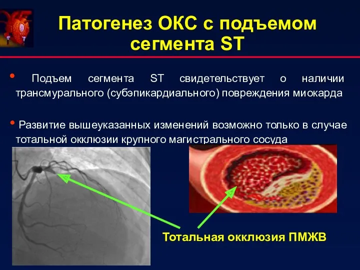 Патогенез ОКС с подъемом сегмента ST Подъем сегмента ST свидетельствует