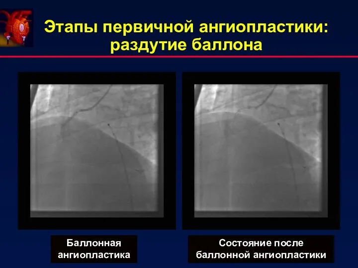 Баллонная ангиопластика Состояние после баллонной ангиопластики Этапы первичной ангиопластики: раздутие баллона