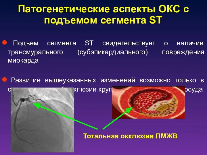 Патогенетические аспекты ОКС с подъемом сегмента ST Подъем сегмента ST