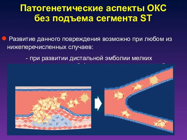 Патогенетические аспекты ОКС без подъема сегмента ST Развитие данного повреждения
