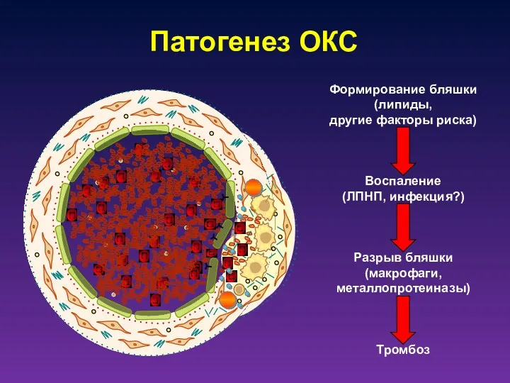 Патогенез ОКС Формирование бляшки (липиды, другие факторы риска) Воспаление (ЛПНП, инфекция?) Разрыв бляшки (макрофаги, металлопротеиназы) Тромбоз