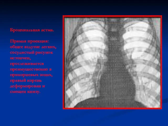 Бронхиальная астма. Прямая проекция: общее вздутие легких, сосудистый рисунок истончен, прослеживается преимущественно в